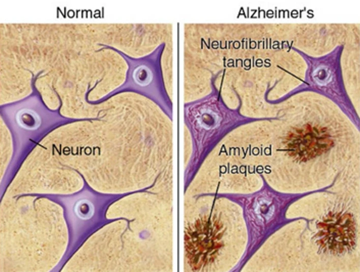 Chiropractic South Sioux City NE Alzheimer's