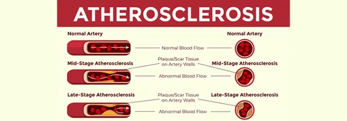 Do You Have Sticky Arteries in South Sioux City NE?