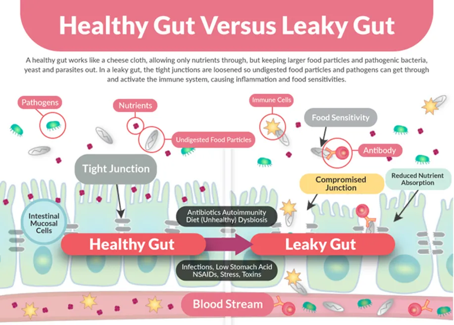 Chiropractic South Sioux City NE Healthy Gut VS Leaky Gut