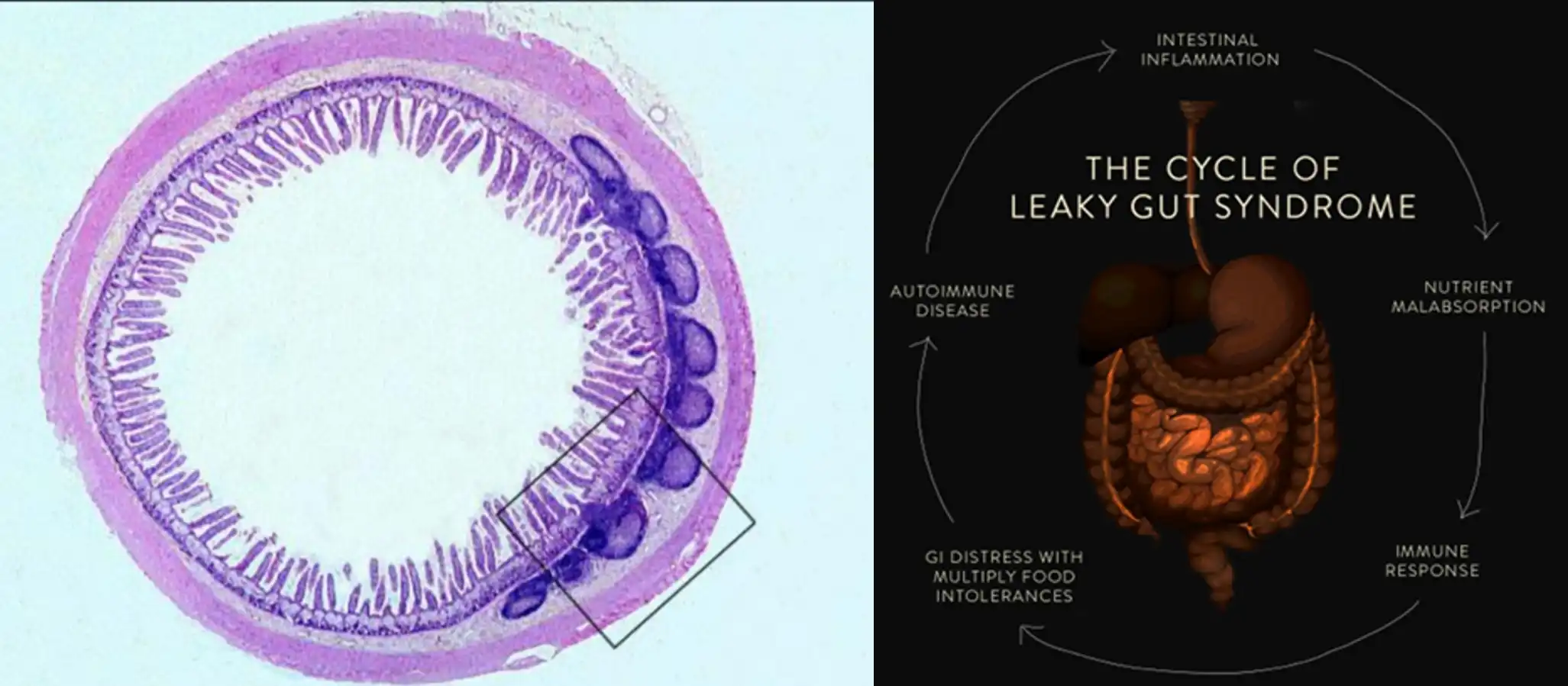 Chiropractic South Sioux City NE Leaky Gut